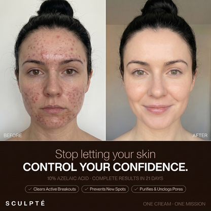 Sculpté Acne Cream