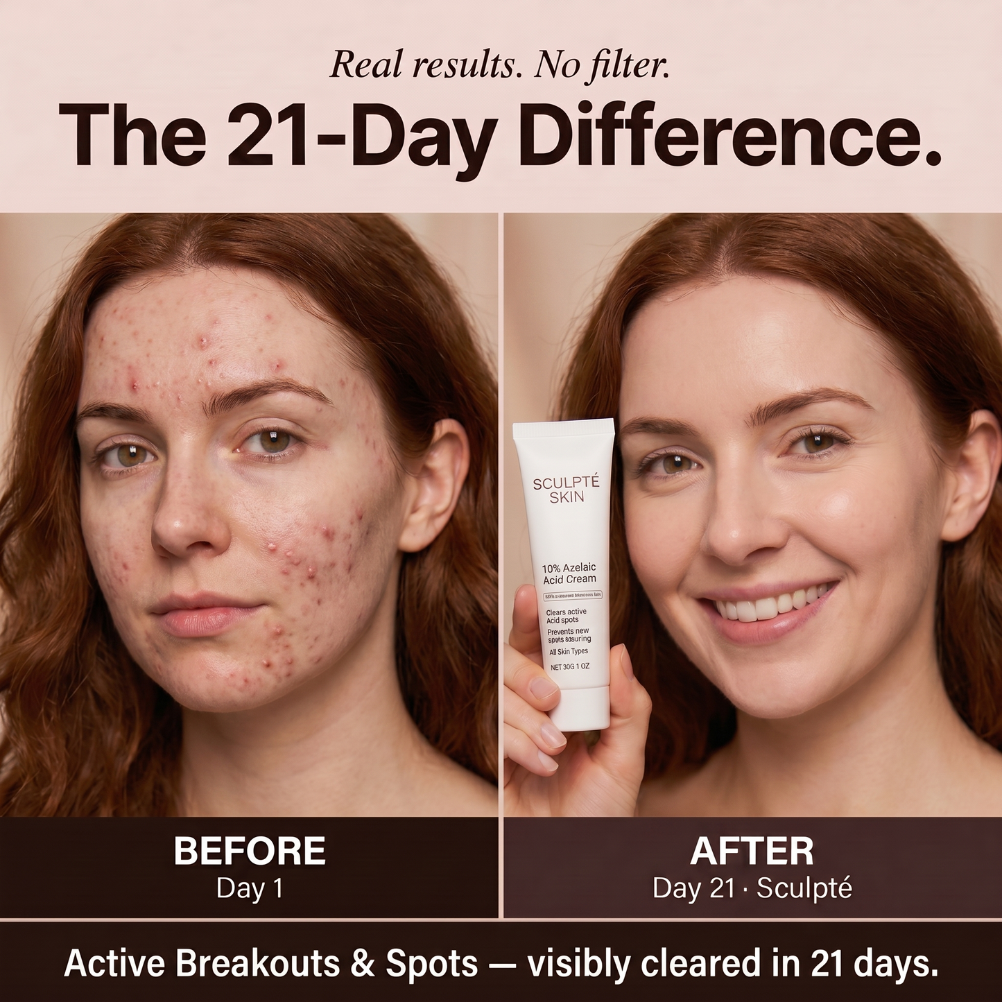 Sculpté Acne Cream