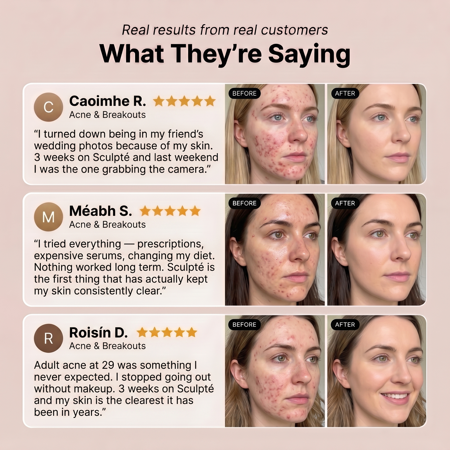 Sculpté Acne Cream